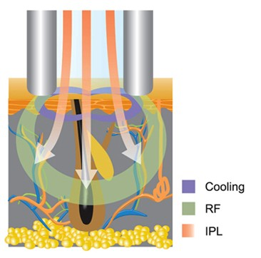 IPL is a non-invasive skin treatment that emits power (2)